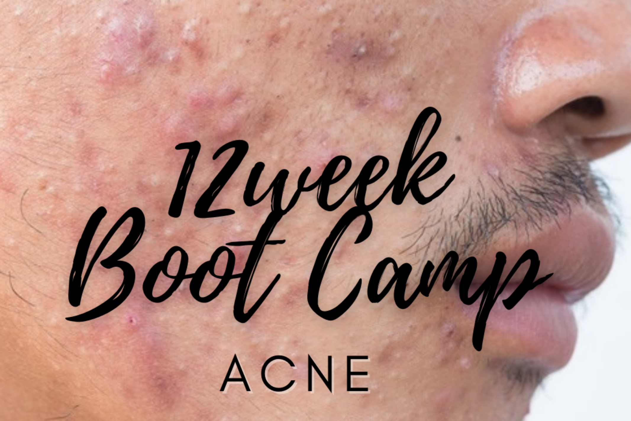 Acne 12 week clear skin