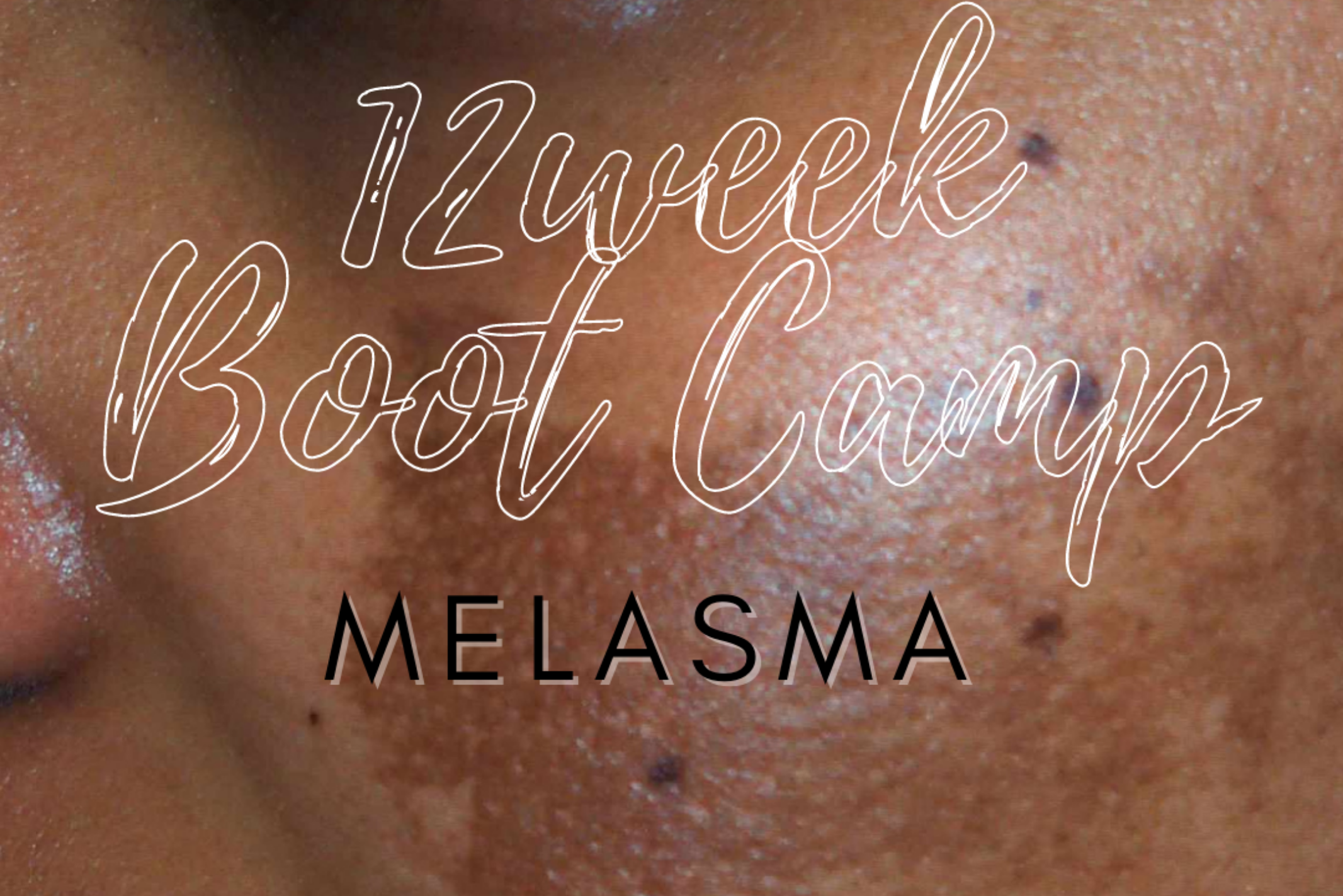 Melasma 12 week healthy skin